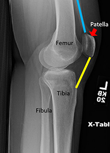 X-ray with the blue lines showing the quadriceps tendon. The yellow line is the patellar tendon.