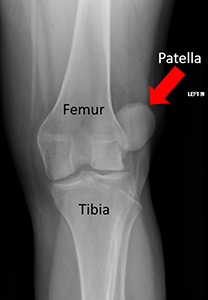 X-ray showing a patellar dislocation. The red arrow points to the patella. It has dislocated laterally or toward the outside of the leg. This is the most common way patellas dislocate. There is no break in the patella.