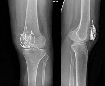 X-ray of a patella fracture treated with wires.