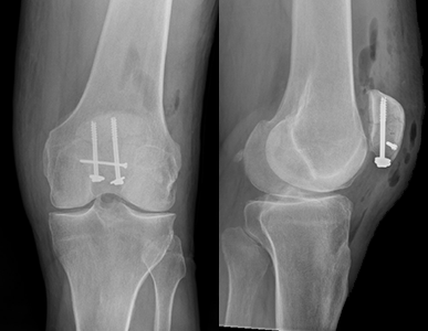X-ray of a patella fracture fixed with screws and strong suture (suture cannot be seen on x-ray).