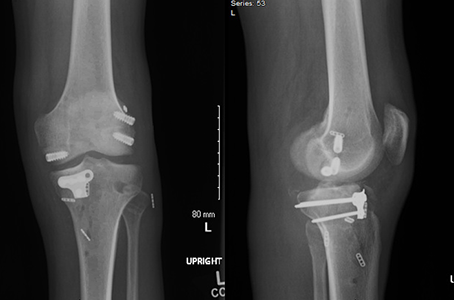 X-rays of a knee that was dislocated and had the ligaments repaired. The different screws and small plates all represent areas where ligaments were repaired.