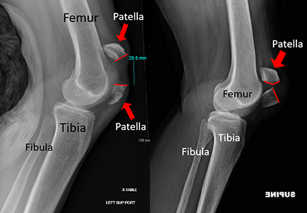 X-rays showing two different patella fractures. The patella can break into two big pieces or into lots of little pieces. The broken pieces are pulled away from each other by the quadriceps (large thigh) muscles. The red lines on the patella show where the breaks are.