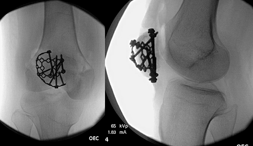 X-ray of a patella fracture treated with a plate.