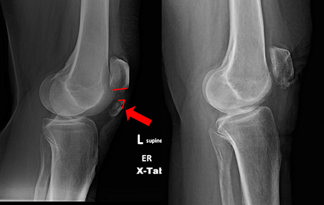 X-rays of a patella fracture treated with strong sutures alone. The x-ray on the left shows the fracture. The x-ray on the right is after the patella has been fixed with strong sutures. The sutures are not seen on the x-ray but they are holding the broken pieces together.