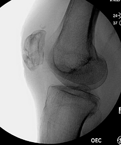 X-ray of a patella after the hardware was removed. The fracture has healed.