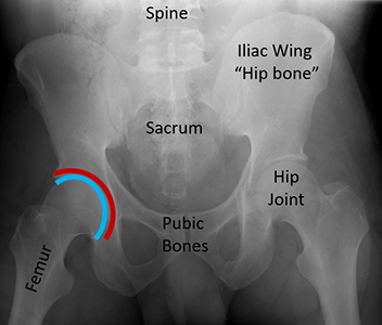 X-ray of a pelvis. The acetabulum is highlighted with a red line; the femoral head with a blue line. The two together make a “ball-in-socket” joint. The hip joint on the opposite side is labeled without the outlines.