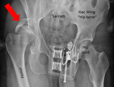 X-ray showing a posterior wall fracture dislocation (red arrow). The other side shows what a normal hip looks like.