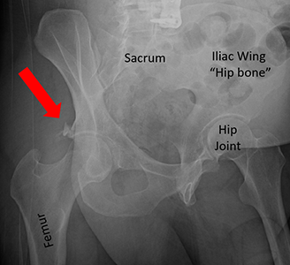X-ray of a small fracture of the posterior wall (red arrow). The femoral head is still located in the correct place.