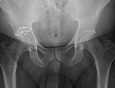 X-ray of a smaller posterior wall acetabular fracture treated with small plates, screws, and wires.