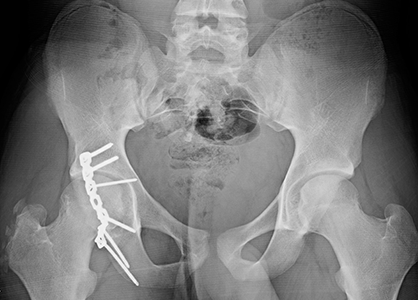 X-ray of a posterior wall acetabular fracture treated with a larger plate and screws.