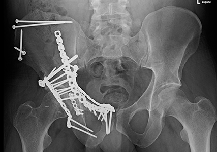 X-ray of a complex acetabular fracture, including a break in the posterior wall and other portions of the acetabulum, that required multiple plates and screws.