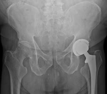 X-ray of a patient treated with a hip replacement.