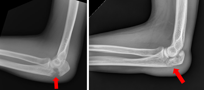 X-ray examples of olecranon fractures.