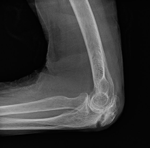 X-ray of an olecranon fracture treated without surgery.