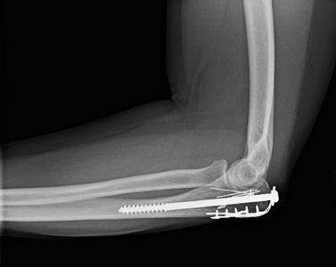 X-ray of an elbow fixed with a combination of plates, screw, and wires.