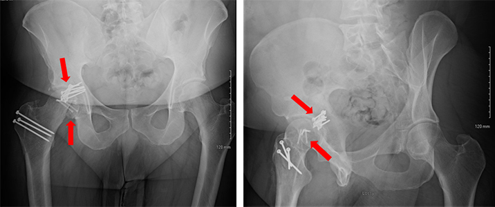 Another femoral head break (left) and a hip socket (acetabular) break (right) fixed with plates and screws.