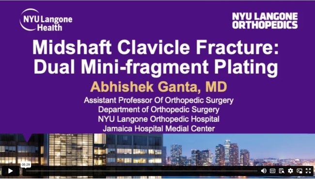 Midshaft Clavicle Fracture Dual Mini-Fragment Plating