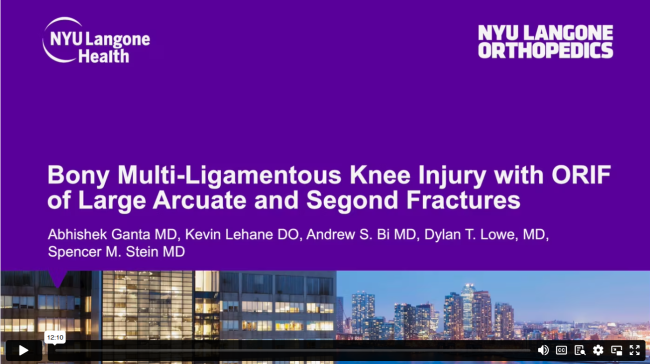 Bony Multi-Ligamentous Knee Injury with ORIF of Large Arcuate and Segond Fractures