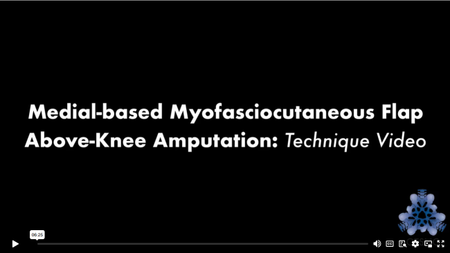 Medial-Based Myofasciocutaneous Flap Above-Knee Amputation: Technique Video