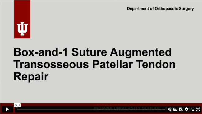 Box-and-1 Suture Augmented Transosseous Patellar Tendon Repair