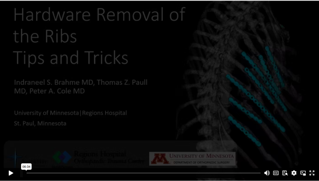 Tips and Tricks for Implant Removal of the Ribs