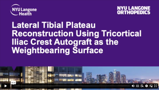 Lateral Tibial Plateau Reconstruction Using Tricortical Iliac Crest Autograft as the Weightbearing Surface
