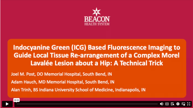 ICG Based Fluorescence Imaging to Guide Local Tissue Re-Arrangement of a Complex Morel Lavalee Lesion about a Hip: A Technical Trick