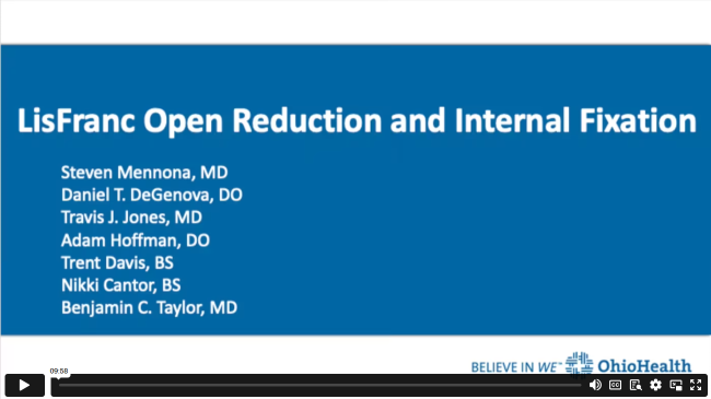 Lisfranc Open Reduction and Internal Fixation
