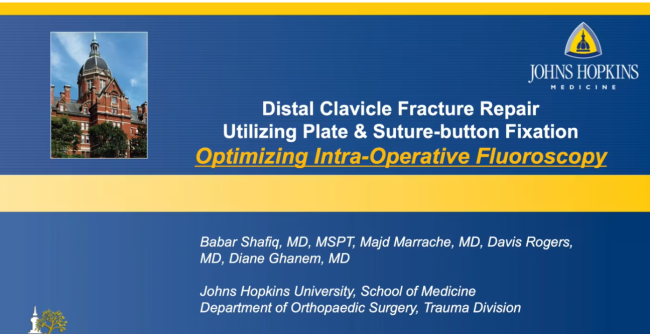 Distal Clavicle Fracture Repair Utilizing Plate & Suture-button Fixation: Optimizing Intra-Operative Fluoroscopy