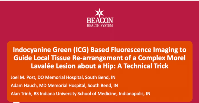 ICG Based Fluorescence Imaging to Guide Local Tissue Re-Arrangement of a Complex Morel Lavalee Lesion about a Hip: A Technical Trick